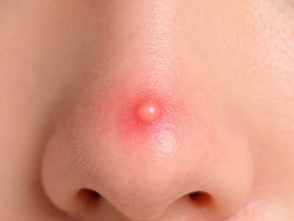 鼻子痘痘感染致命