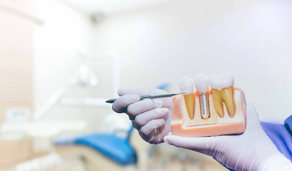 SG老人植牙推荐