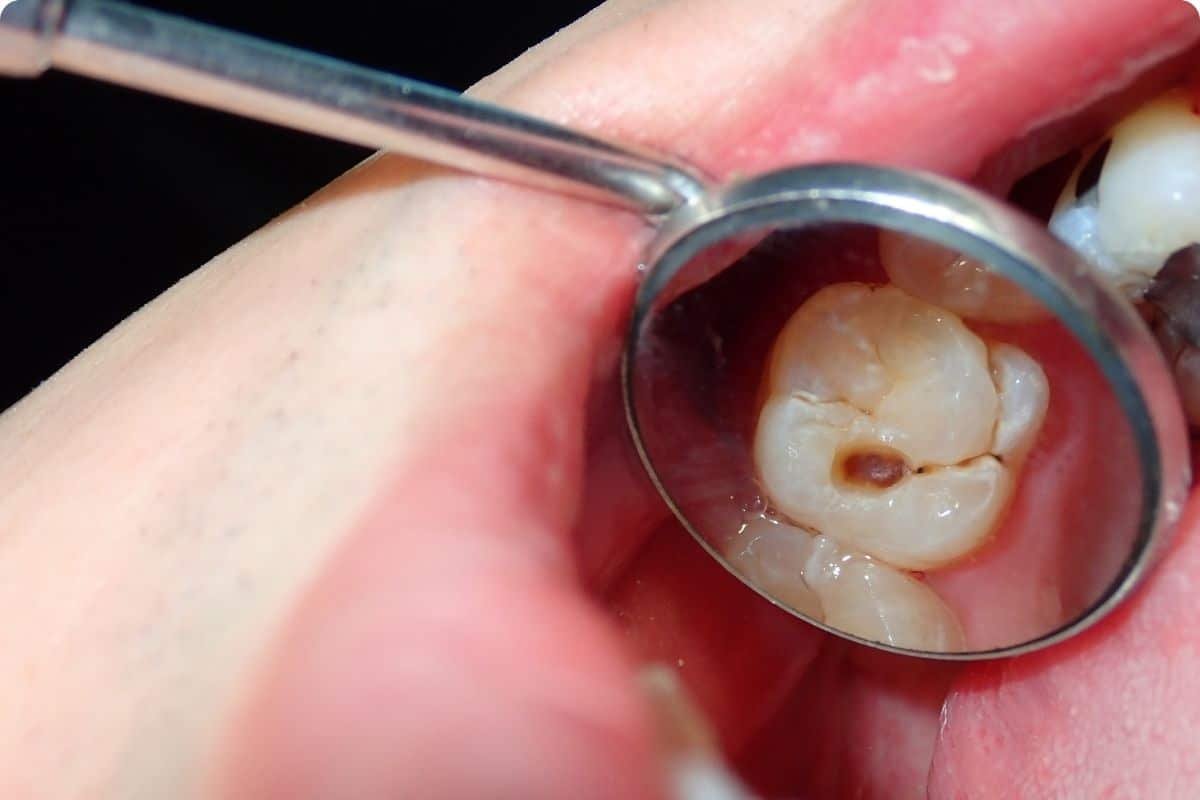 新加坡家庭必看的补牙价格